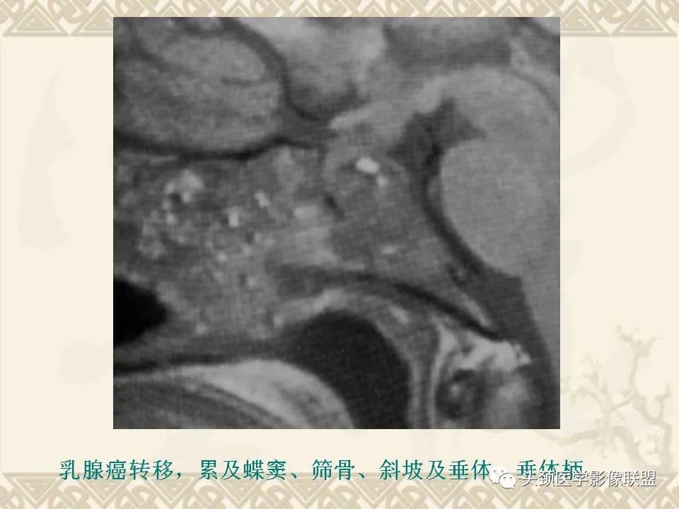 影像PPT - 【PPT】颅骨肿瘤的影像学诊断与鉴别诊断-108