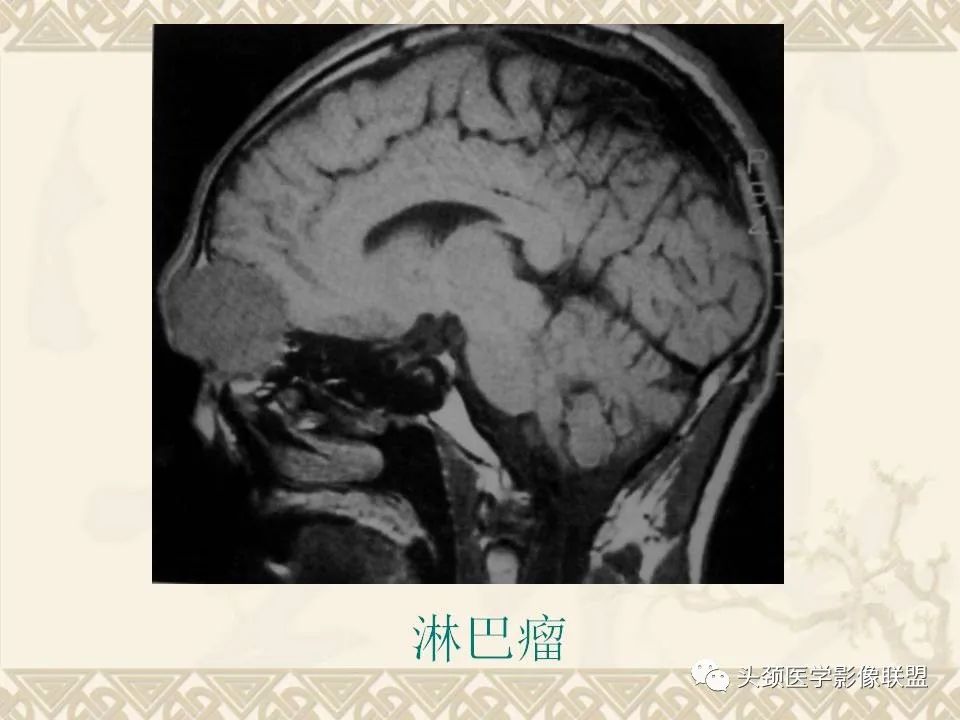 影像PPT - 【PPT】颅骨肿瘤的影像学诊断与鉴别诊断-107