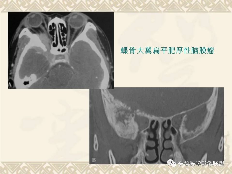 影像PPT - 【PPT】颅骨肿瘤的影像学诊断与鉴别诊断-111