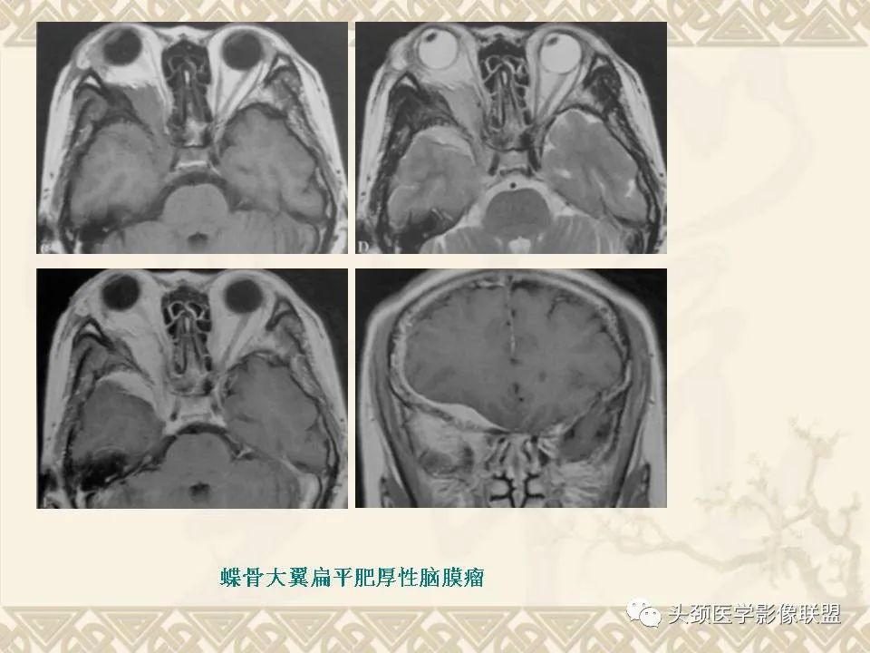 影像PPT - 【PPT】颅骨肿瘤的影像学诊断与鉴别诊断-112