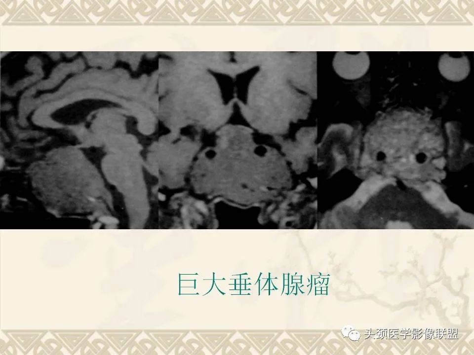 影像PPT - 【PPT】颅骨肿瘤的影像学诊断与鉴别诊断-113