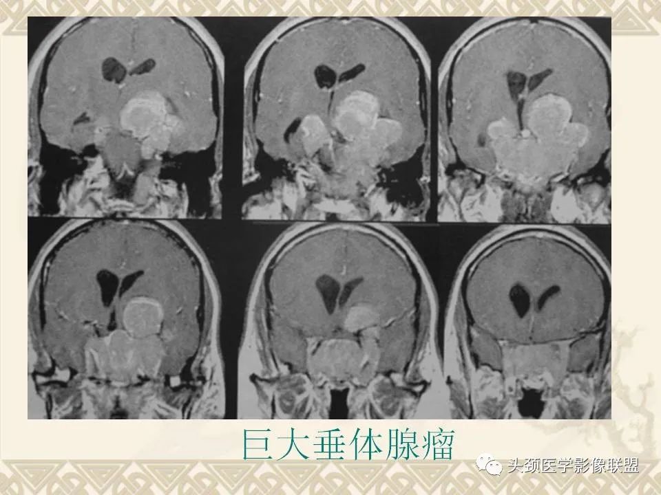 影像PPT - 【PPT】颅骨肿瘤的影像学诊断与鉴别诊断-115