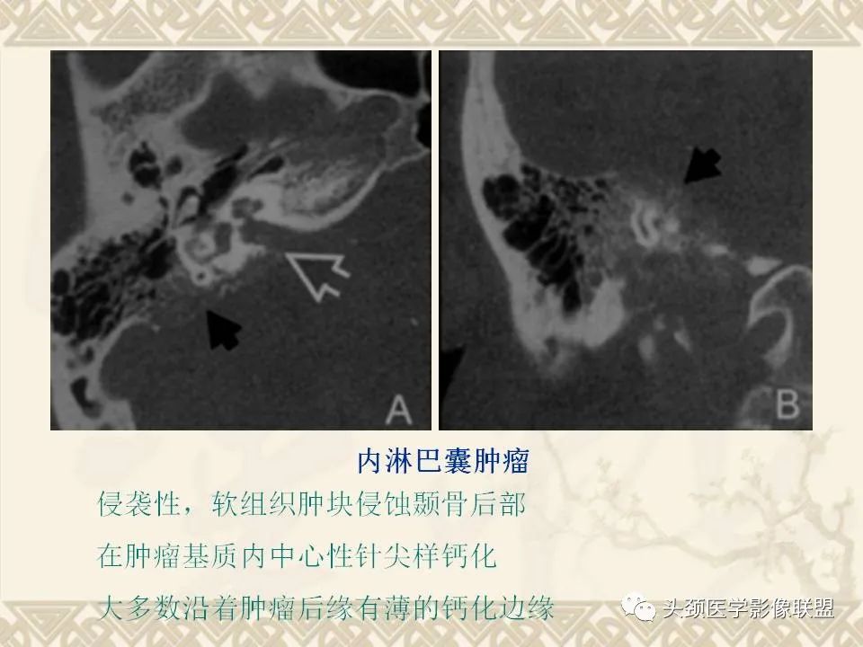 影像PPT - 【PPT】颅骨肿瘤的影像学诊断与鉴别诊断-116