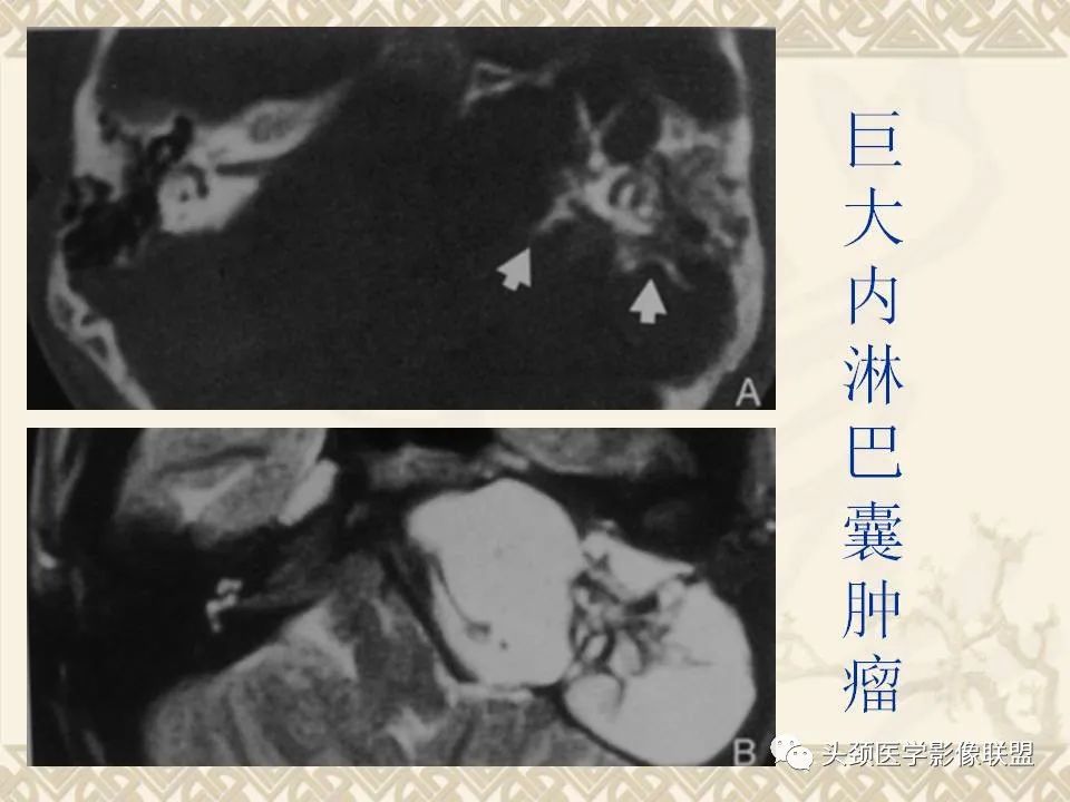 影像PPT - 【PPT】颅骨肿瘤的影像学诊断与鉴别诊断-118