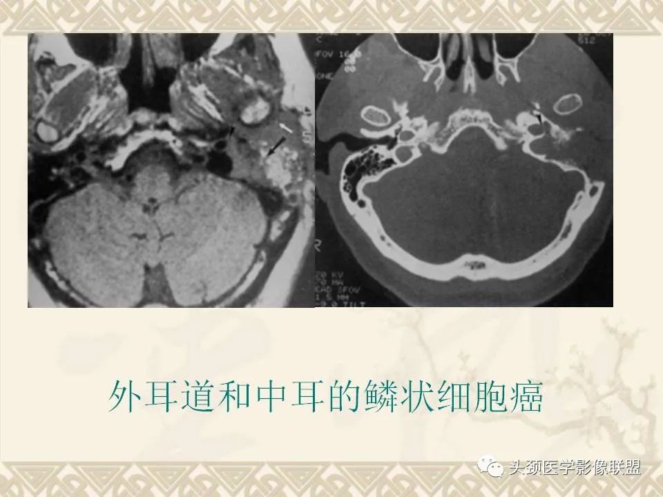 影像PPT - 【PPT】颅骨肿瘤的影像学诊断与鉴别诊断-121