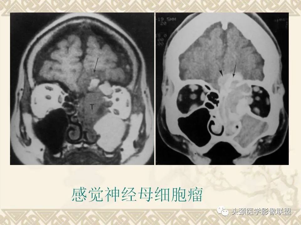 影像PPT - 【PPT】颅骨肿瘤的影像学诊断与鉴别诊断-122