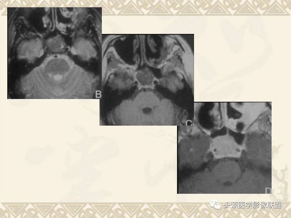 影像PPT - 【PPT】颅骨肿瘤的影像学诊断与鉴别诊断-126