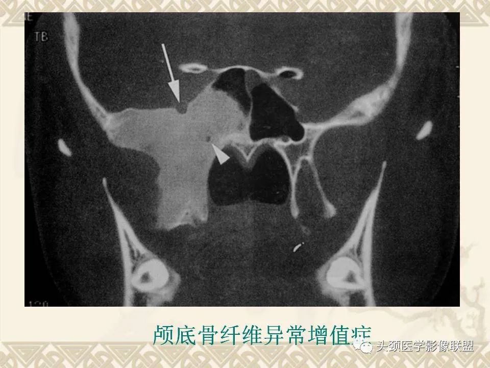 影像PPT - 【PPT】颅骨肿瘤的影像学诊断与鉴别诊断-125