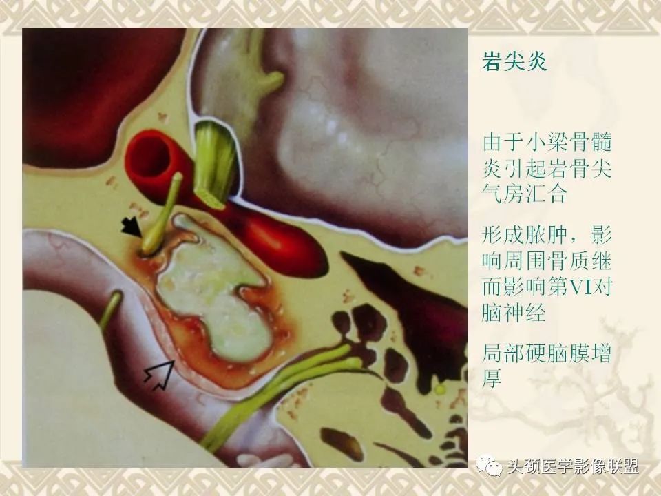 影像PPT - 【PPT】颅骨肿瘤的影像学诊断与鉴别诊断-128