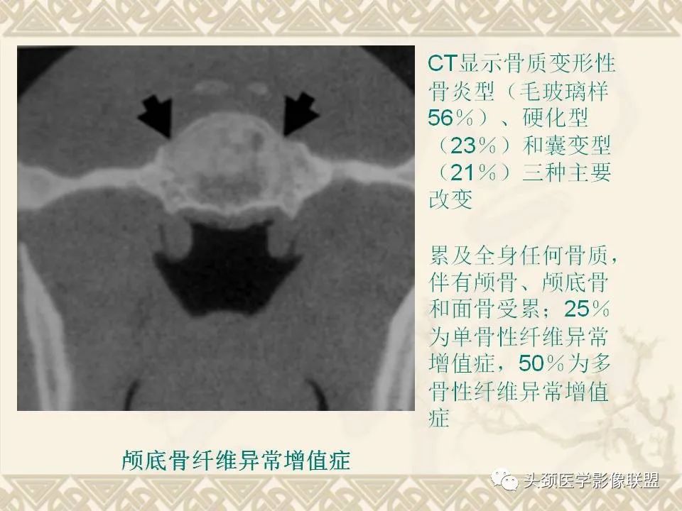 影像PPT - 【PPT】颅骨肿瘤的影像学诊断与鉴别诊断-127
