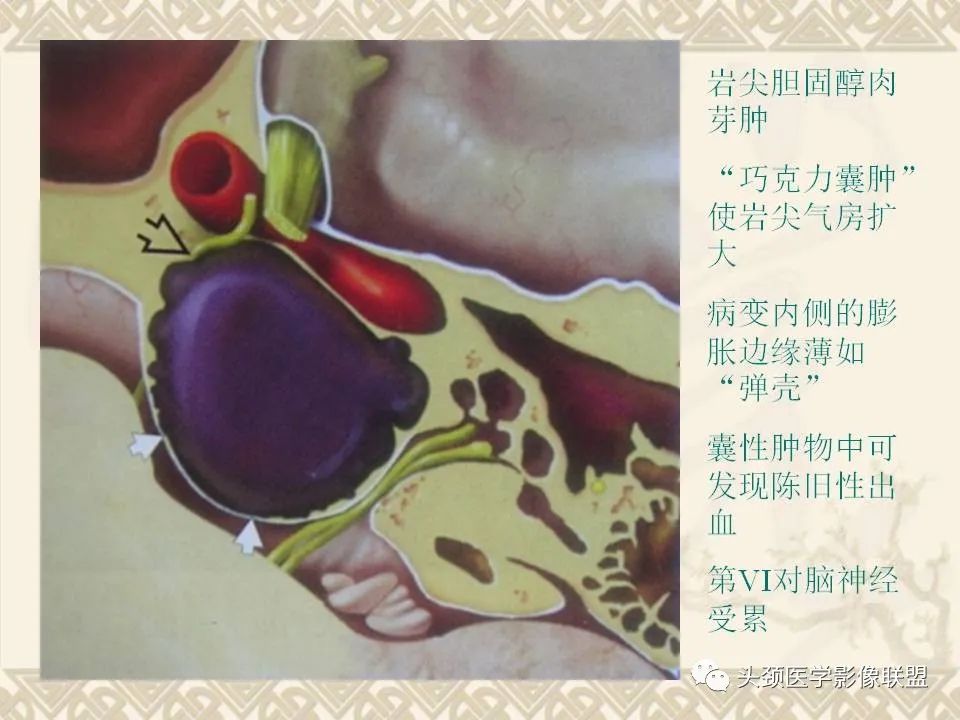 影像PPT - 【PPT】颅骨肿瘤的影像学诊断与鉴别诊断-130
