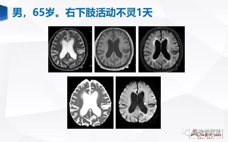 影像PPT - 【PPT】DWI在脑卒中诊断中的作用-10