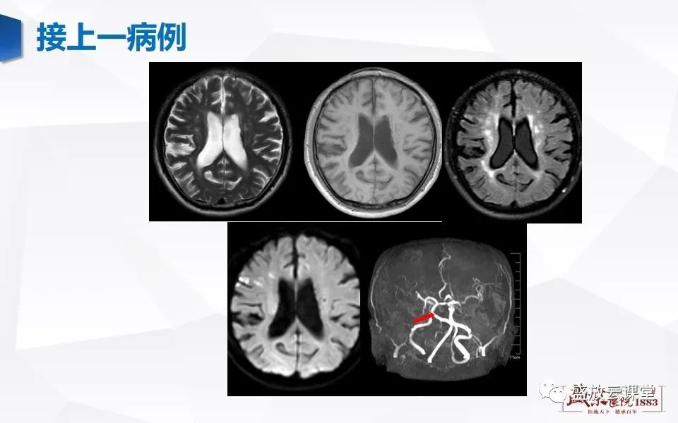 影像PPT - 【PPT】DWI在脑卒中诊断中的作用-12