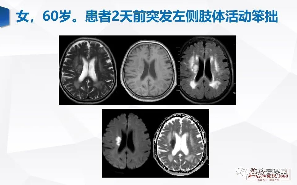 影像PPT - 【PPT】DWI在脑卒中诊断中的作用-11