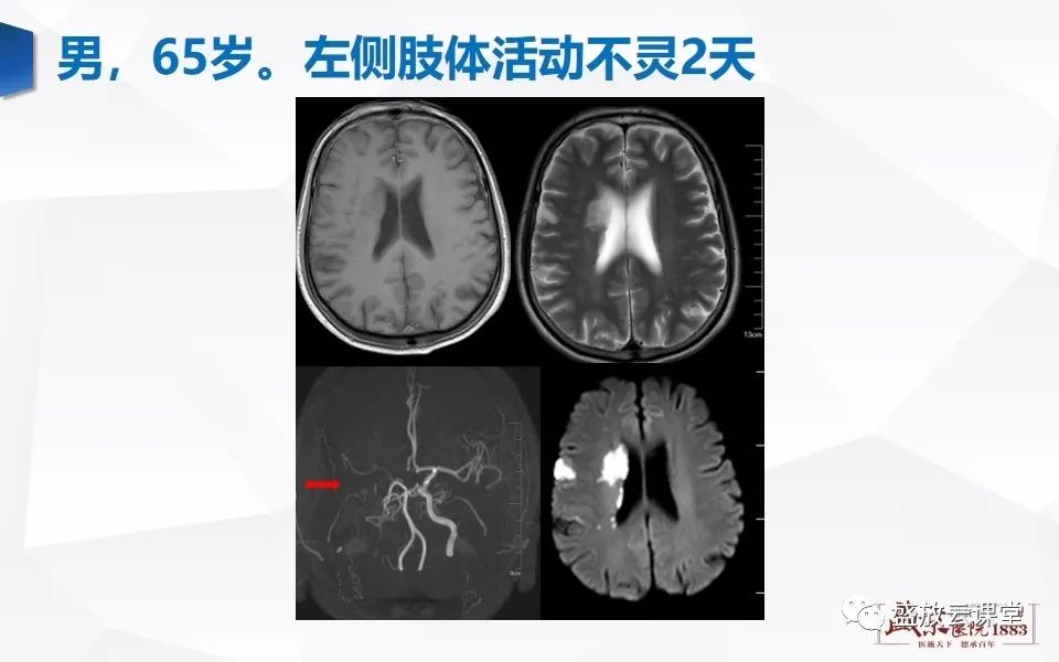 影像PPT - 【PPT】DWI在脑卒中诊断中的作用-14
