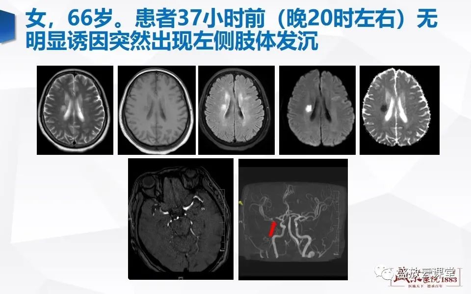 影像PPT - 【PPT】DWI在脑卒中诊断中的作用-13