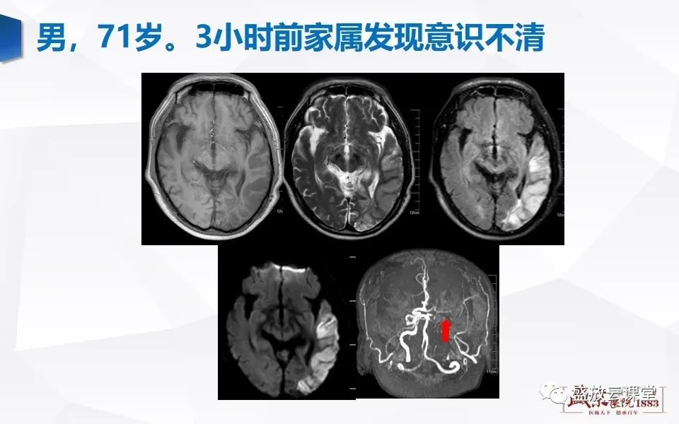 影像PPT - 【PPT】DWI在脑卒中诊断中的作用-16
