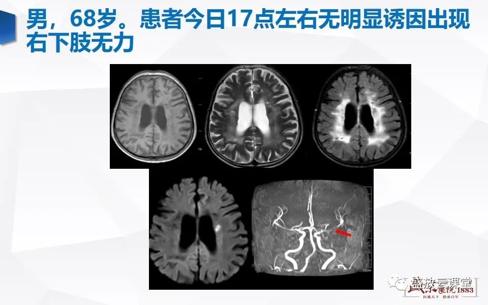 影像PPT - 【PPT】DWI在脑卒中诊断中的作用-15
