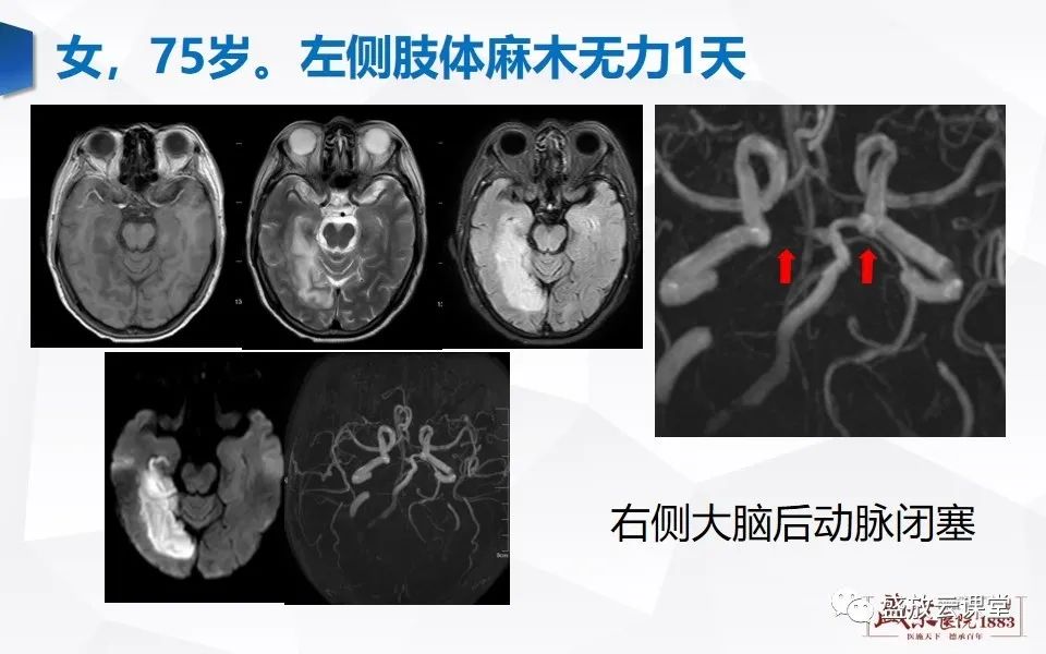 影像PPT - 【PPT】DWI在脑卒中诊断中的作用-17