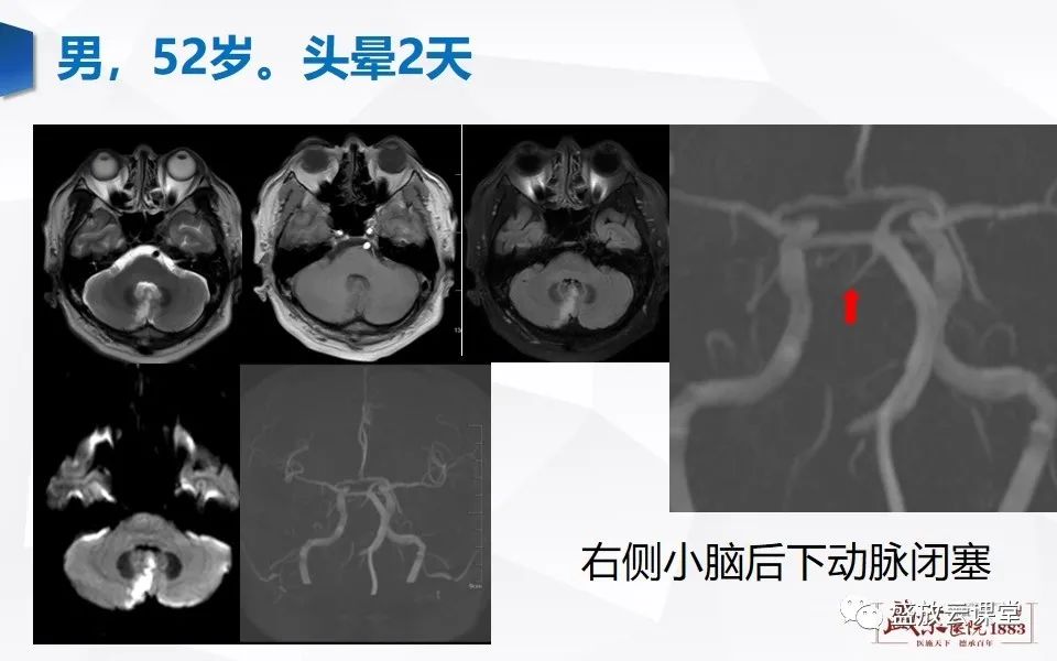 影像PPT - 【PPT】DWI在脑卒中诊断中的作用-18