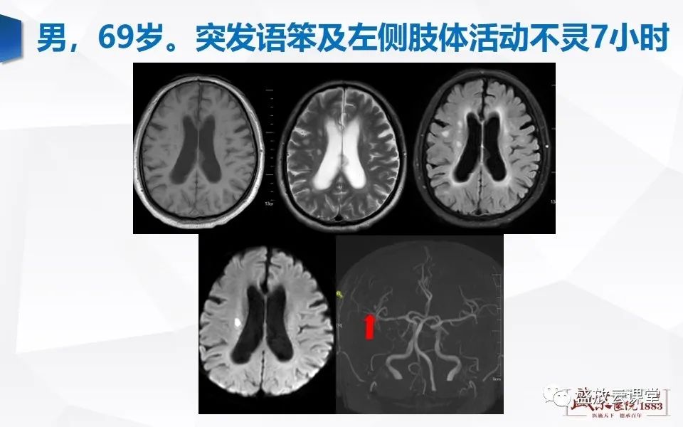 影像PPT - 【PPT】DWI在脑卒中诊断中的作用-19