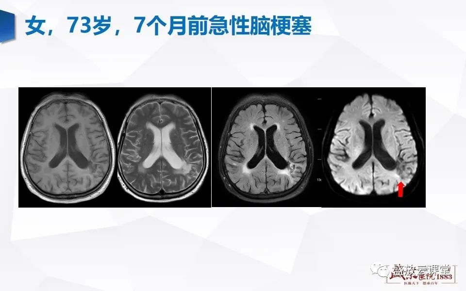 影像PPT - 【PPT】DWI在脑卒中诊断中的作用-21