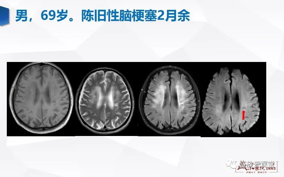 影像PPT - 【PPT】DWI在脑卒中诊断中的作用-22