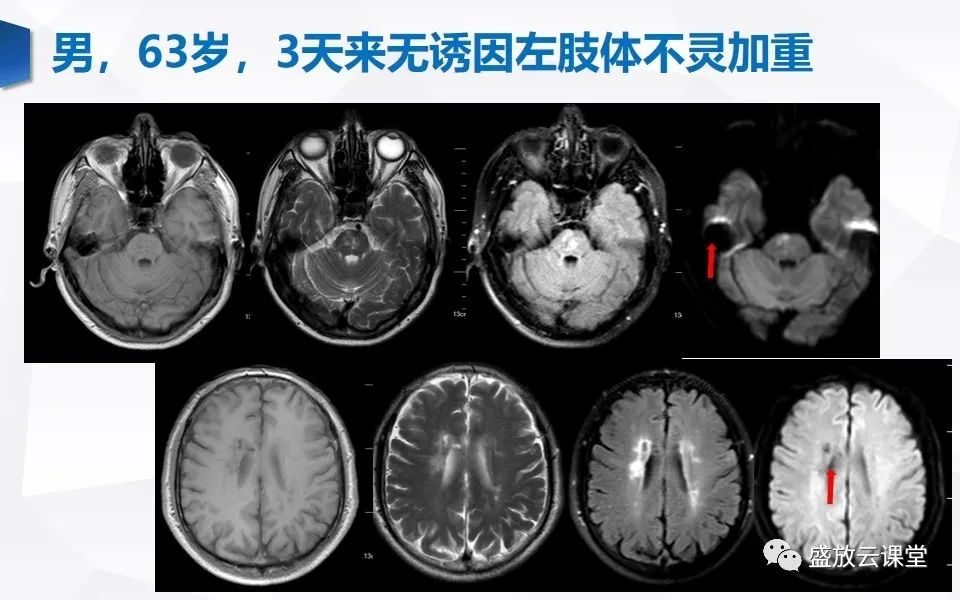 影像PPT - 【PPT】DWI在脑卒中诊断中的作用-23