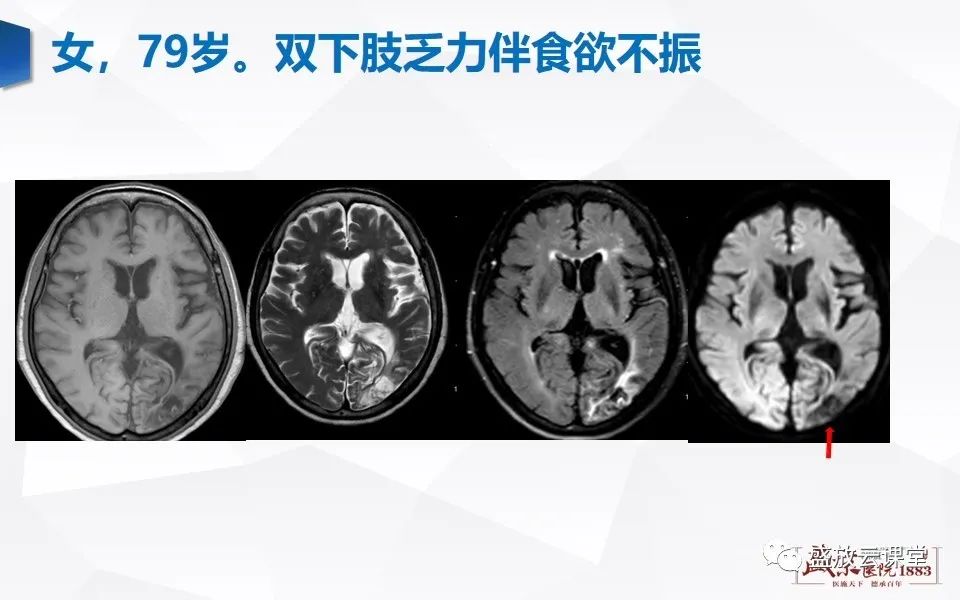 影像PPT - 【PPT】DWI在脑卒中诊断中的作用-24