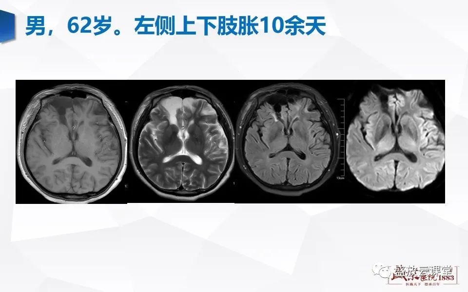 影像PPT - 【PPT】DWI在脑卒中诊断中的作用-25