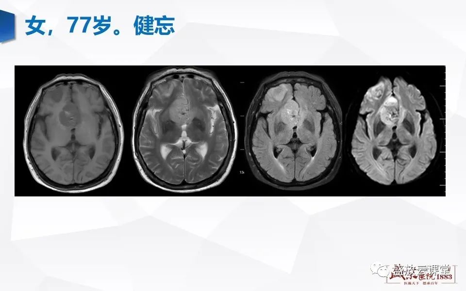影像PPT - 【PPT】DWI在脑卒中诊断中的作用-27