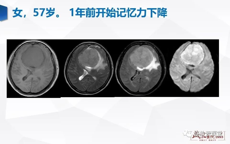 影像PPT - 【PPT】DWI在脑卒中诊断中的作用-28