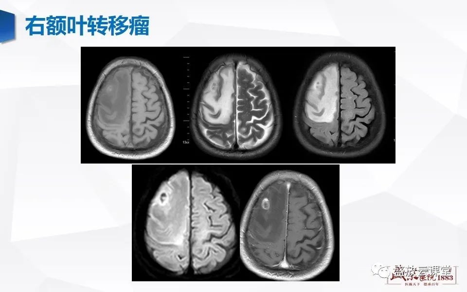 影像PPT - 【PPT】DWI在脑卒中诊断中的作用-29