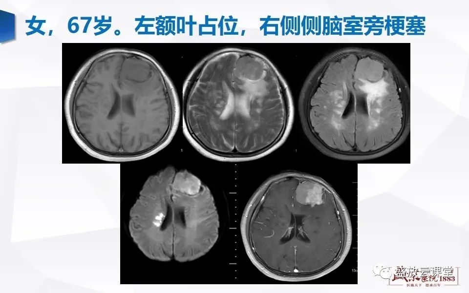 影像PPT - 【PPT】DWI在脑卒中诊断中的作用-30
