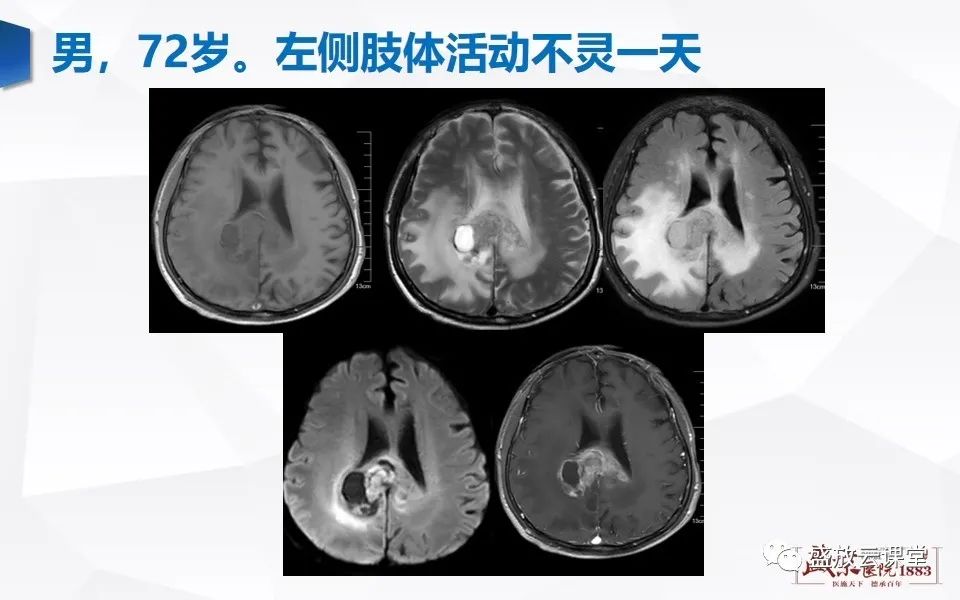 影像PPT - 【PPT】DWI在脑卒中诊断中的作用-31