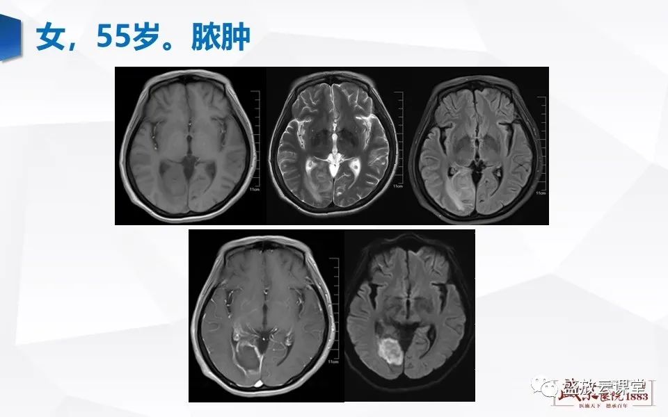 影像PPT - 【PPT】DWI在脑卒中诊断中的作用-34