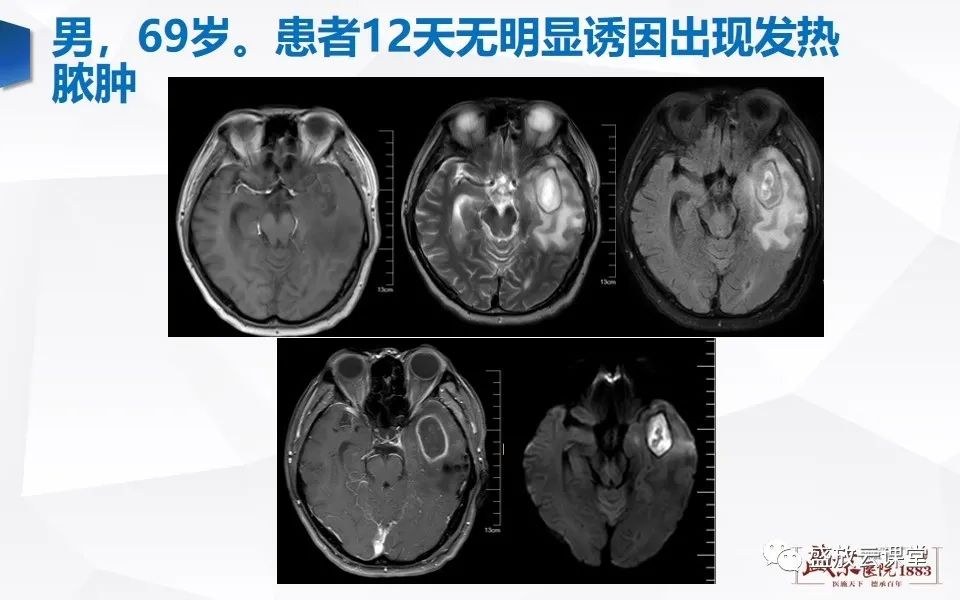 影像PPT - 【PPT】DWI在脑卒中诊断中的作用-33