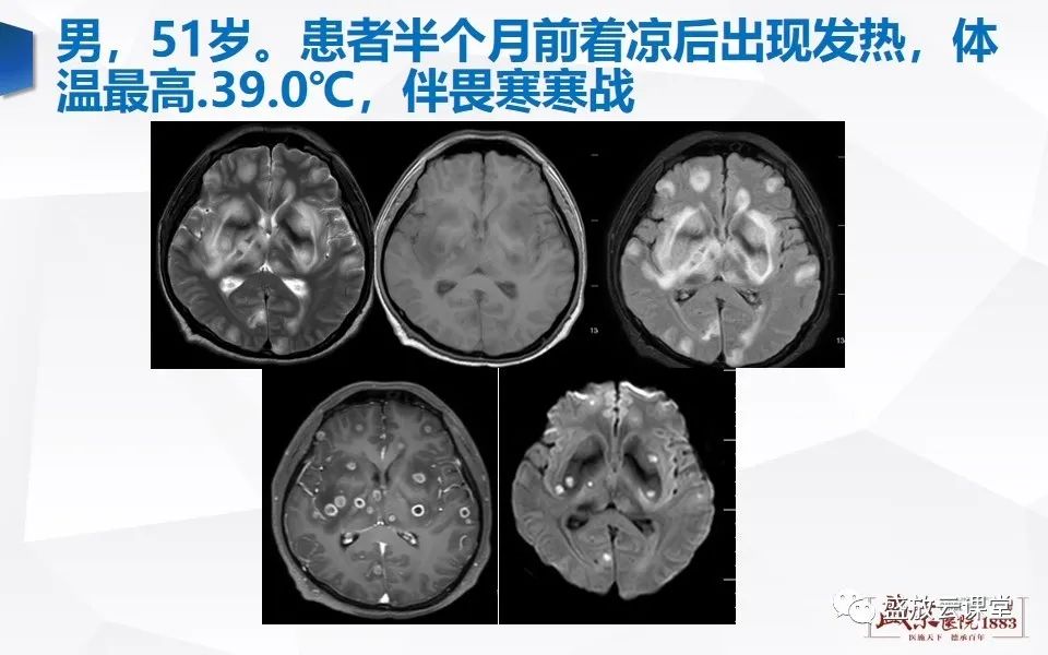 影像PPT - 【PPT】DWI在脑卒中诊断中的作用-35
