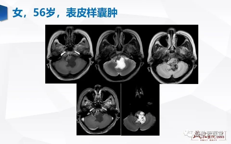 影像PPT - 【PPT】DWI在脑卒中诊断中的作用-36