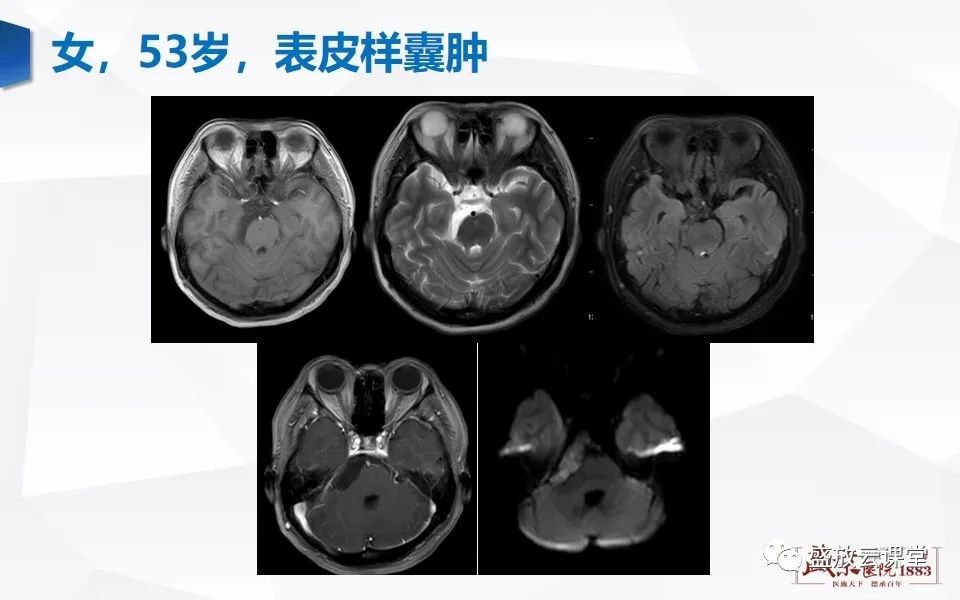 影像PPT - 【PPT】DWI在脑卒中诊断中的作用-37