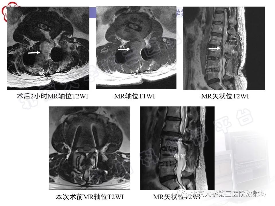 影像PPT - 【PPT】脊柱术后硬膜外血肿-4