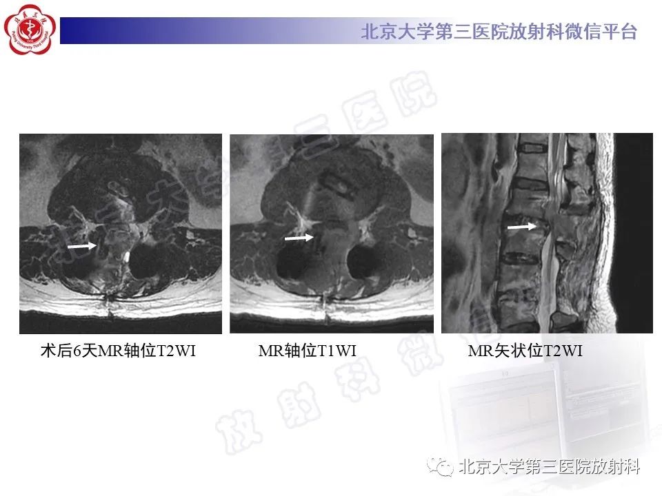 影像PPT - 【PPT】脊柱术后硬膜外血肿-6