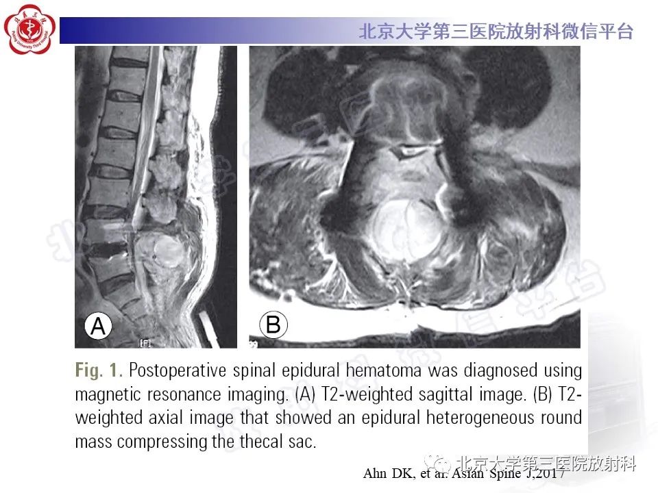 影像PPT - 【PPT】脊柱术后硬膜外血肿-17