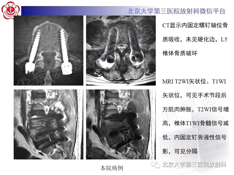影像PPT - 【PPT】脊柱术后硬膜外血肿-21