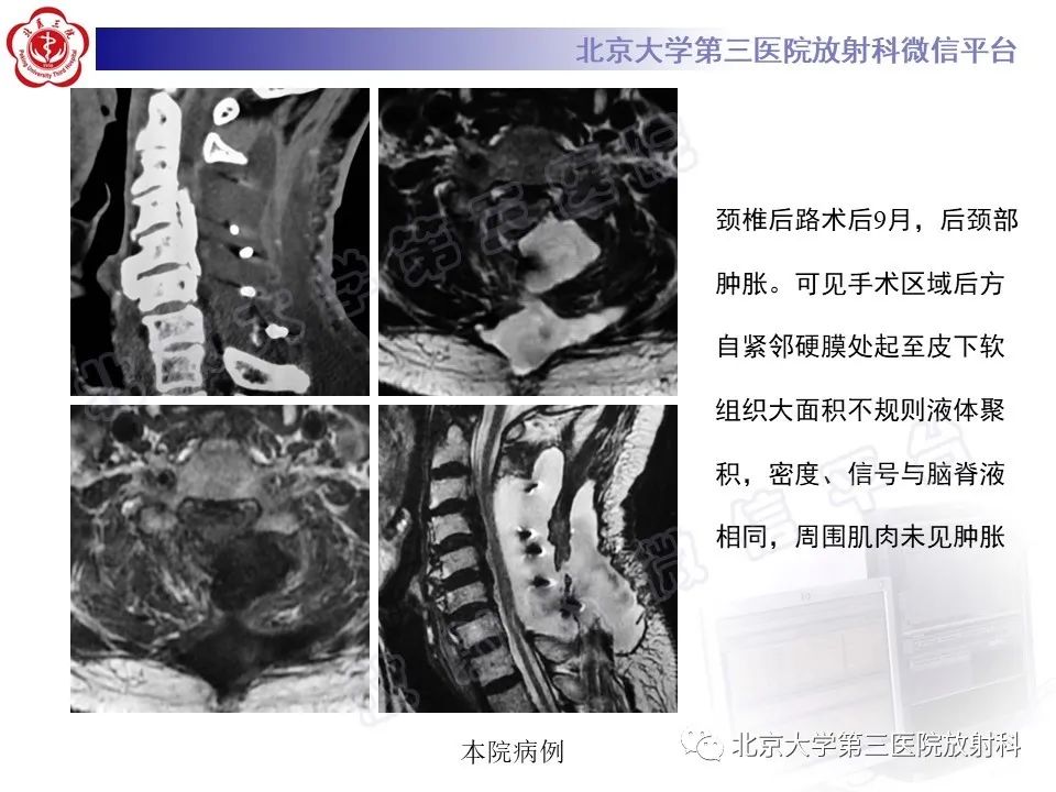 影像PPT - 【PPT】脊柱术后硬膜外血肿-23