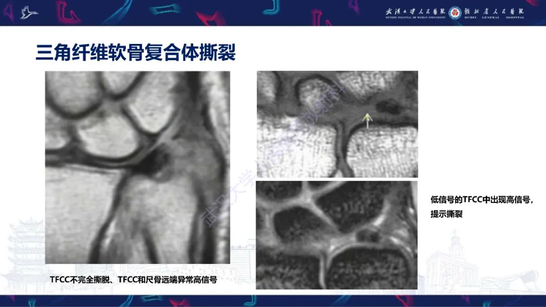 影像PPT - 【PPT】腕关节疼痛MRI评估-7