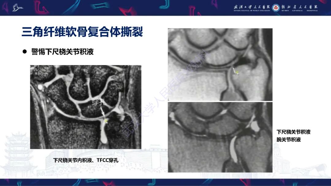 影像PPT - 【PPT】腕关节疼痛MRI评估-9
