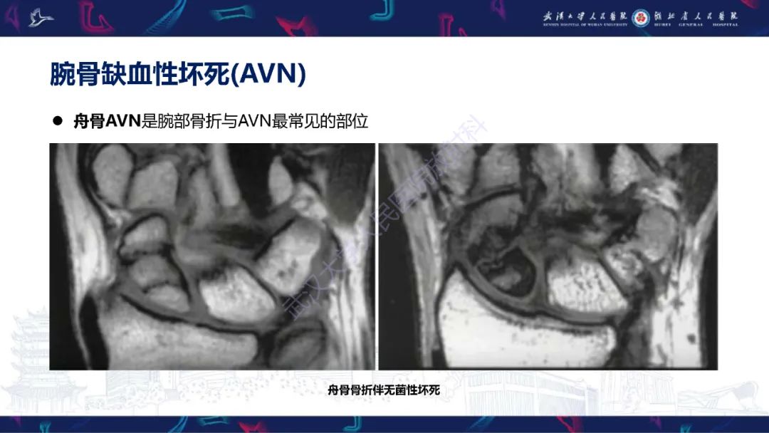 影像PPT - 【PPT】腕关节疼痛MRI评估-13