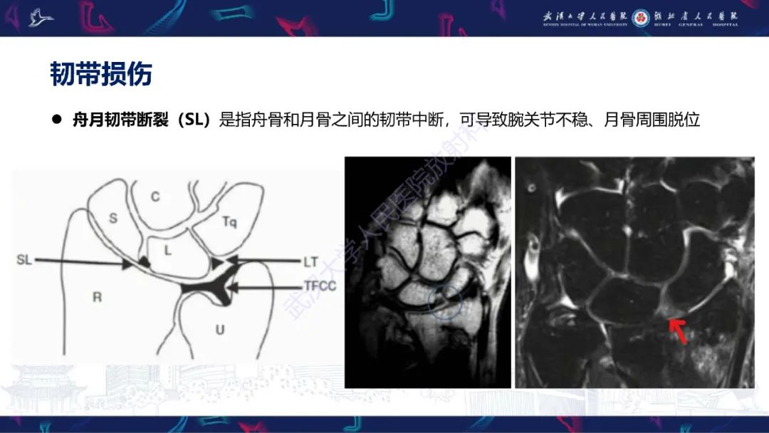 影像PPT - 【PPT】腕关节疼痛MRI评估-11