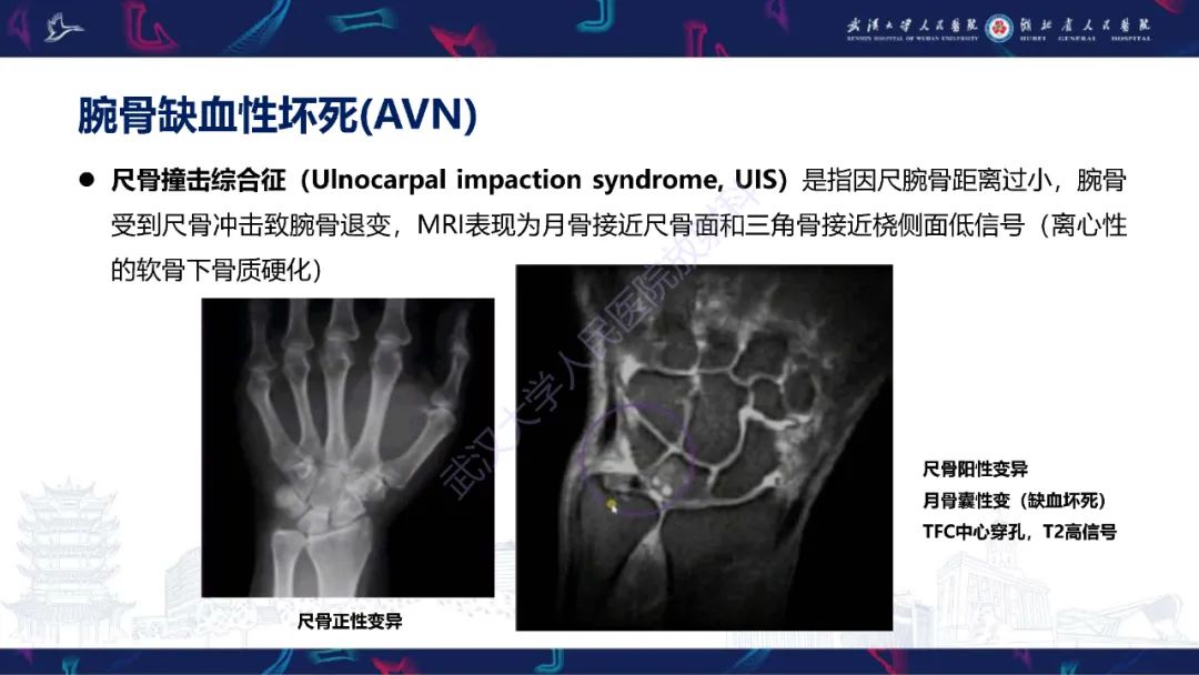 影像PPT - 【PPT】腕关节疼痛MRI评估-15